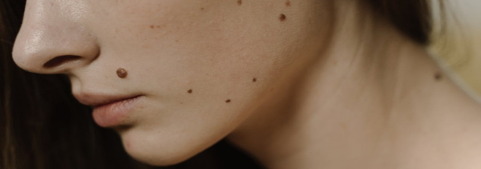 סרח עור סרטני - מתי מדובר בממצא שדורש בירור?