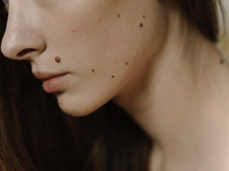 סרח עור סרטני - מתי מדובר בממצא שדורש בירור?