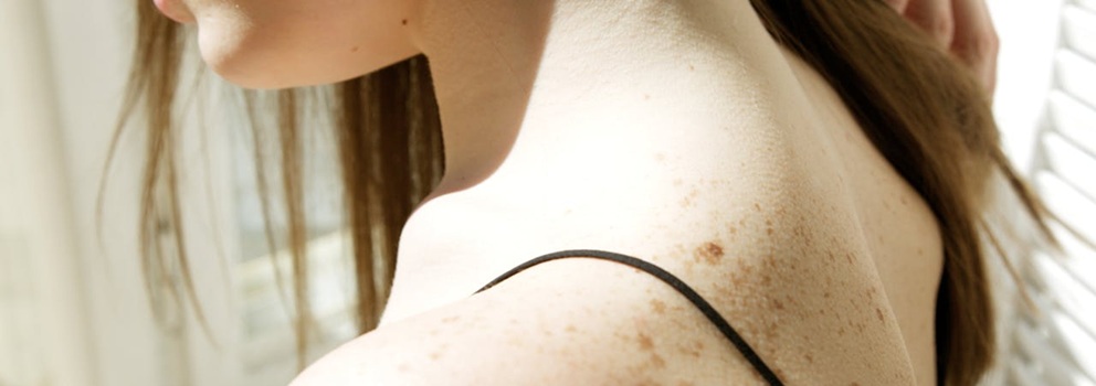 ביופסית עור - מתי עושים ולמה זה חשוב