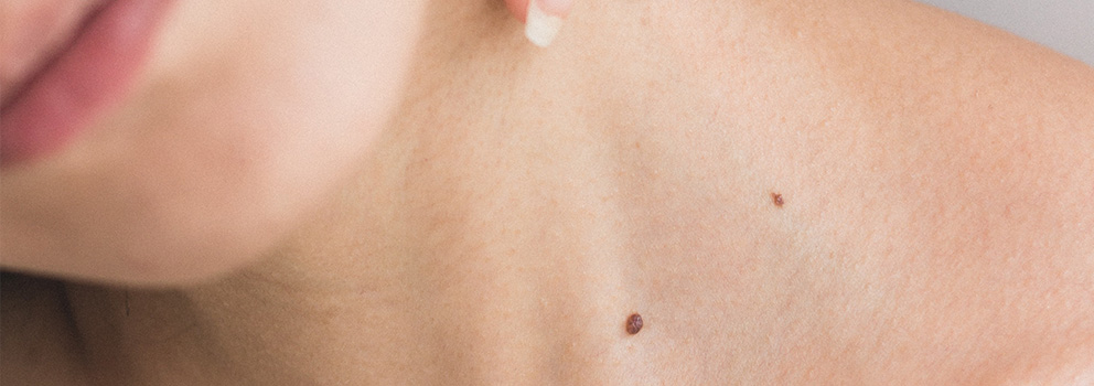 אבחון מוקדם של סרטן העור
