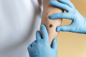 מיתוסים על מלנומה